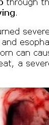 asymptomatic,
